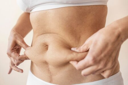 L’abdominoplastie : Retrouver un ventre sculpté et une silhouette harmonieuse